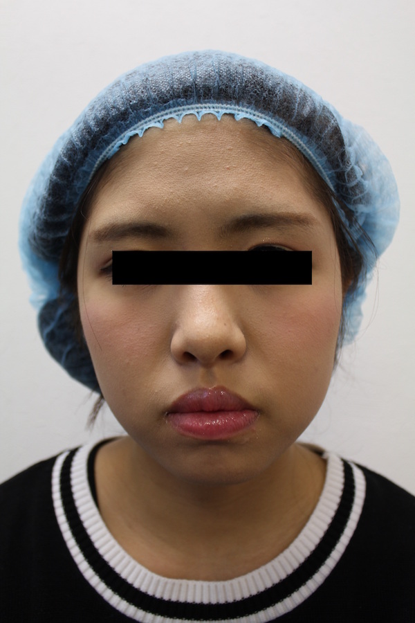东京青山整形美容医院 BNLS瘦脸针 手术后
