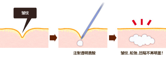 注射透明质酸/皱纹 松弛 凹陷不再明显！