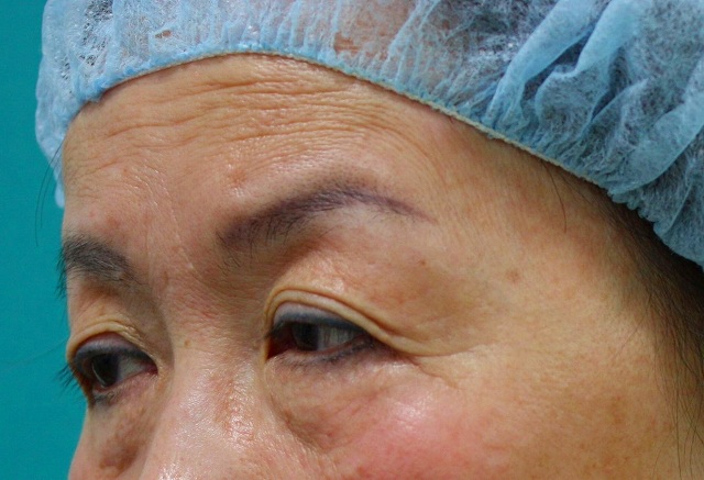 有效改善额头，眉间，眼窝等部位的表情纹的治疗“肉毒杆菌注射” | 东京 