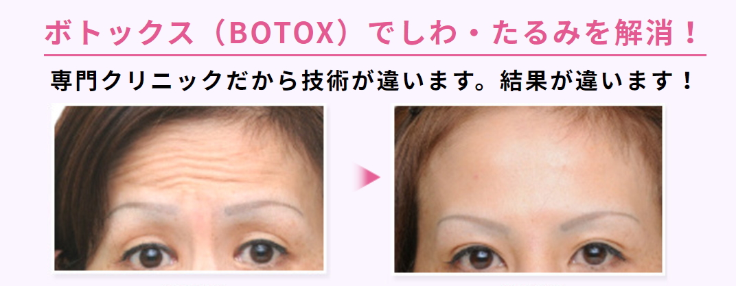 是 什么 botox botox是什么(注射botox除皱好不)_环球信息网