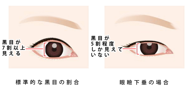 眼睑下垂治疗