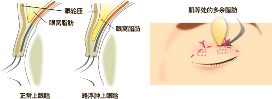 出正常上眼睑/略浮肿上眼睑/眼窝脂肪/眼轮匝/肌等处的多余脂肪