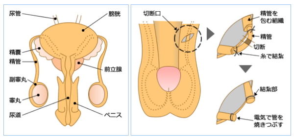 输精管结扎